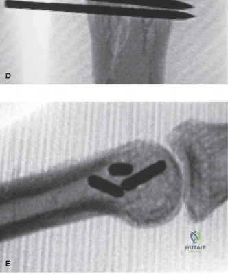 صورة توضيحية لـ كسور السلاميات القريبة في الأصابع: دليل شامل للتشخيص والعلاج والتعافي مع الأستاذ الدكتور محمد هطيف