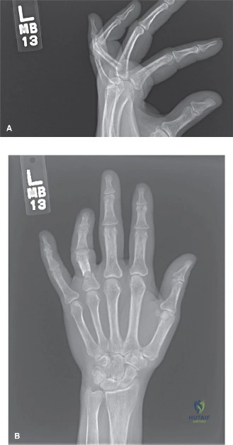 Illustration of reduction and percutaneous pin - Dr. Mohammed Hutaif