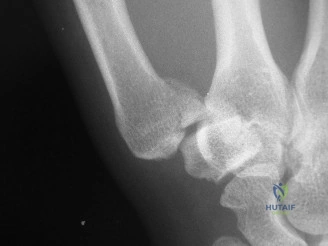 صورة توضيحية لـ كسر بينيت في الإبهام: دليل شامل للتشخيص والعلاج والتعافي مع الأستاذ الدكتور محمد هطيف في صنعاء