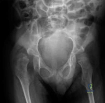 صورة توضيحية لـ كسر عظم الفخذ لدى الأطفال المصابين بالشلل الدماغي ونقص كثافة العظام: دليل شامل للآباء