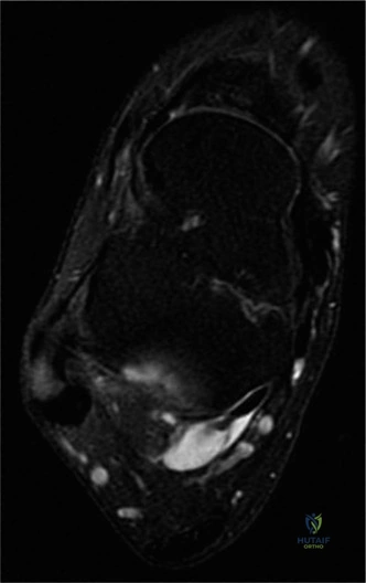 Flexor Hallucis Longus Pathology: Comprehensive Orthopedic Review & Surgical Reference