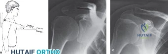 Illustration of elbow cases acromioclavicular - Dr. Mohammed Hutaif
