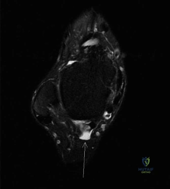 Flexor Hallucis Longus Tenosynovitis & Os Trigonum Syndrome: A Ballet Dancer Case Study