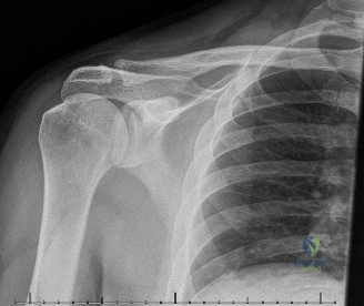 فك شفرة شلل العصب الإبطي في إصابات المرفق المعقدة: قصة إصابة كتف خفية