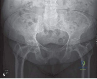 Illustration of oncology cases paget - Dr. Mohammed Hutaif
