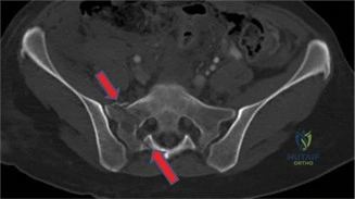 Illustration of case sacral fracture - Dr. Mohammed Hutaif
