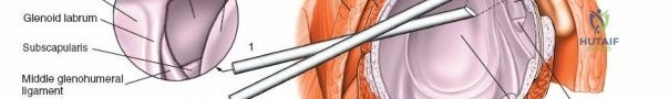 صورة توضيحية لـ كسور البيلون (قصبة الساق البعيدة): دليل شامل للمرضى مع الأستاذ الدكتور محمد هطيف في صنعاء