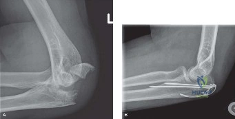 Illustration of tension band wire - Dr. Mohammed Hutaif