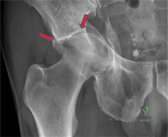 Illustration of case acetabular fractures - Dr. Mohammed Hutaif