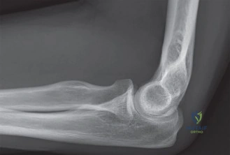 Illustration of coronoid fractures coronoid - Dr. Mohammed Hutaif