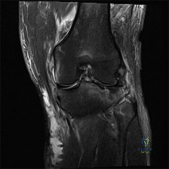 High-Energy Schatzker Type VI Tibial Plateau Fracture: A Case Study with Neurovascular Compromise