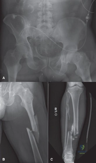 Illustration of damage control orthopaedics - Dr. Mohammed Hutaif