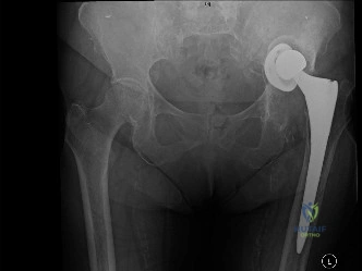 Illustration of painful total hip - Dr. Mohammed Hutaif