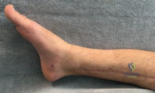 صورة توضيحية لـ كسر قصبة الساق والبلافون المعقد: دليل شامل للعلاج والتعافي مع الأستاذ الدكتور محمد هطيف