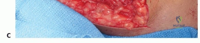صورة توضيحية لـ استئصال الجزء البعيد من عظم العضد: تقنيات آمنة للحفاظ على الطرف في صنعاء مع الأستاذ الدكتور محمد هطيف