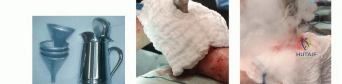 صورة توضيحية لـ تجنب الجراحة الكبرى: علاج أورام العظام بالنيتروجين السائل بتقنية الصب المباشر