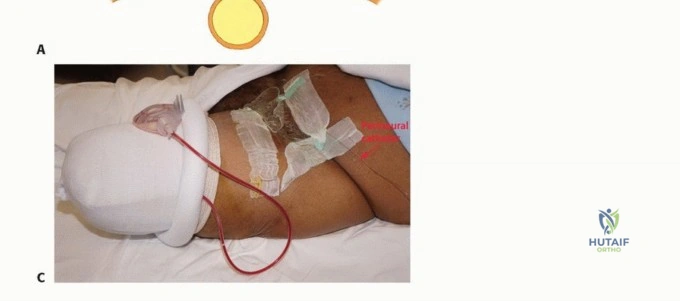 صورة توضيحية لـ بتر فوق الركبة: دليل شامل للمرضى وخيارات التعافي مع الأستاذ الدكتور محمد هطيف