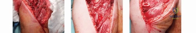 صورة توضيحية لـ جراحة نقائل عظم العضد: دليل شامل لاستعادة الوظيفة وتخفيف الألم في اليمن مع الأستاذ الدكتور محمد هطيف