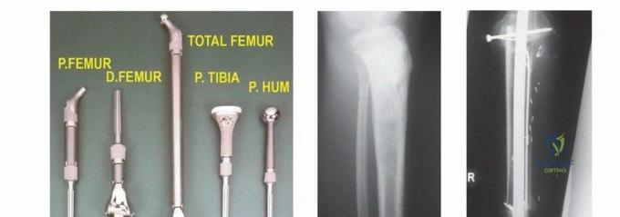 صورة توضيحية لـ أورام العظام والأنسجة الرخوة: دليلك الشامل للفهم والعلاج مع الأستاذ الدكتور محمد هطيف