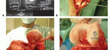 صورة توضيحية لـ الأطراف الصناعية القابلة للتمدد للأطفال: دليل شامل للمرضى حول الوقاية من العدوى والعلاج في صنعاء مع الأستاذ الدكتور محمد هطيف