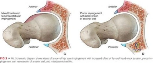 صورة توضيحية لـ تنظير مفصل الفخذ الدقيق: علاج متقدم لآلام الورك المعقدة مع الأستاذ الدكتور محمد هطيف في صنعاء