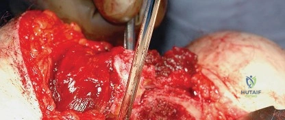 صورة توضيحية لـ النهج الخلفي لمفصل الورك: دليل شامل لاستعادة الحركة في صنعاء مع الأستاذ الدكتور محمد هطيف