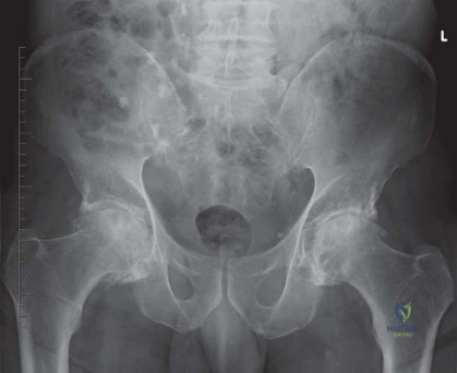 صورة طبية: الرقبة المعيارية Kinectiv® Stem لمفصل الورك الصناعي: حلول متطورة لنجاح جراحة استبدال مفصل الورك مع الأستاذ الدكتور محمد هطيف في صنعاء