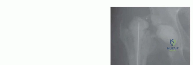 صورة توضيحية لـ جراحة استئصال مفصل الورك والمباعدات: حلول متقدمة لعدوى المفصل الصناعي مع الأستاذ الدكتور محمد هطيف في صنعاء