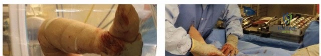 صورة توضيحية لـ ساق الفخذ المدبب: دليل شامل لتثبيت مفصل الورك اللاأسمنتي طويل الأمد مع الأستاذ الدكتور محمد هطيف في صنعاء