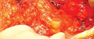صورة توضيحية لـ المدخل الخلفي الجانبي لجراحة استبدال مفصل الورك الكلي: دليل شامل للمرضى في صنعاء مع الأستاذ الدكتور محمد هطيف