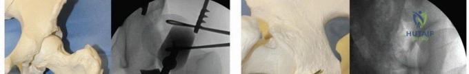 صورة توضيحية لـ جراحة قطع العظم حول الحُق وقطع عظم الفخذ: إعادة محاذاة مفصل الورك لراحة دائمة مع الأستاذ الدكتور محمد هطيف
