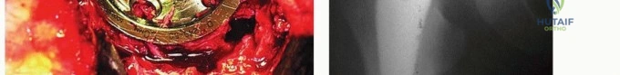 صورة توضيحية لـ هشاشة العظام حول مفصل الورك الاصطناعي تبديل بطانة البولي إيثيلين الحل الأمثل