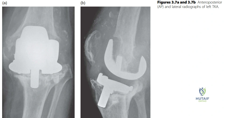 Illustration of revision knee replacement - Dr. Mohammed Hutaif