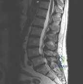 صورة توضيحية لـ استعادة استقامة الرقبة: جراحات العظام المتقدمة لعلاج الحداب العنقي مع الأستاذ الدكتور محمد هطيف
