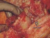 صورة توضيحية لـ انضغاط جذور الأعصاب العنقية: دليل شامل للتشخيص والعلاج مع الأستاذ الدكتور محمد هطيف