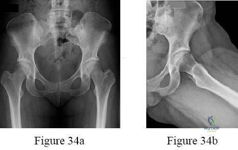 Elbow Revision: When a Patient Sustained a Complex Injury Pattern