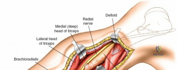 دليل شامل لكسور العضد، متلازمة الحيز، وكسور الإجهاد: العلاج والوقاية مع الأستاذ الدكتور محمد هطيف في صنعاء