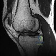 صورة توضيحية لـ الكسور المعقدة والإصابات العظمية المفصلية: دليل شامل للتشخيص والعلاج مع الأستاذ الدكتور محمد هطيف في صنعاء