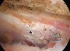 صورة توضيحية لـ دليل شامل لجراحات العظام: المداخل الجراحية، المخاطر، والتعافي مع الأستاذ الدكتور محمد هطيف في صنعاء