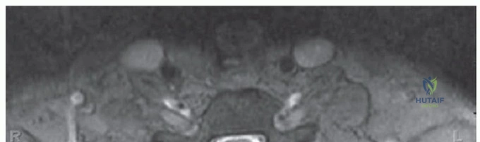 صورة توضيحية لـ خشونة المفاصل في الورك والركبة: دليل شامل للعلاج والوقاية مع الأستاذ الدكتور محمد هطيف في صنعاء