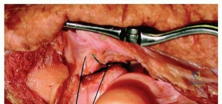 صورة توضيحية لـ خشونة المفاصل وتشوهاتها في الركبة والكاحل: دليل شامل للعلاج والوقاية مع الأستاذ الدكتور محمد هطيف
