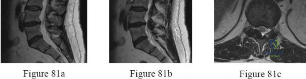 صورة توضيحية لـ جراحة ترميم الرباط الجانبي الوحشي للمرفق: دليل شامل للمرضى لاستعادة استقرار المرفق وحركته