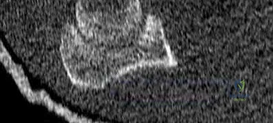 صورة توضيحية لـ كسور الجزء العلوي من عظم العضد: دليل المريض الشامل للتشخيص والعلاج والتعافي