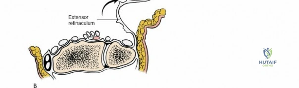 صورة توضيحية لـ كسور عظم العضد القريب: دليل شامل للمرضى مع الأستاذ الدكتور محمد هطيف