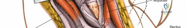 المسمار النخاعي لقصبة الساق: دليل المريض الشامل للتعافي من كسور الساق في اليمن