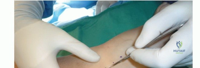 صورة توضيحية لـ التهاب وتر أخيلس الإدخالي: دليلك الشامل للتخلص من آلام الكعب مع الدكتور محمد هطيف