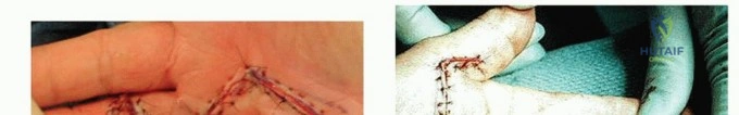 صورة توضيحية لـ وداعاً لألم الكعب المزمن: الدليل الشامل لمتلازمة هاغلوند وعلاجها بالمنظار مع الأستاذ الدكتور محمد هطيف