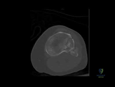 صورة توضيحية لـ كسور رأس وعنق الكعبرة: دليل المريض الشامل للتشخيص والعلاج والتعافي مع الأستاذ الدكتور محمد هطيف في اليمن