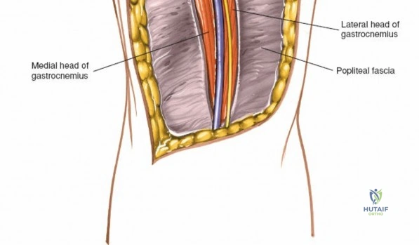 صورة توضيحية لـ أكياس العظام الأحادية (الكيس العظمي البسيط): دليل المرضى الشامل مع الأستاذ الدكتور محمد هطيف