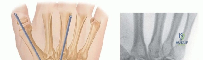 اعادة تأهيل القدم: دليلك الشامل للتعافي التام والنجاح.